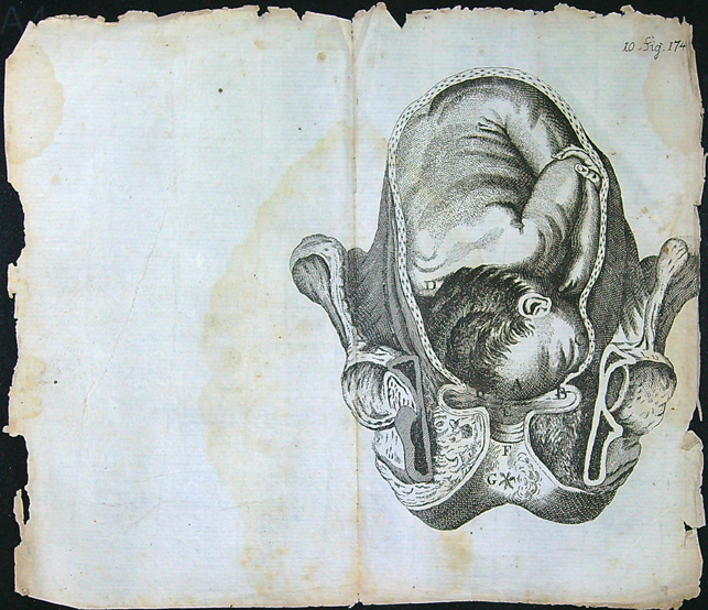 Grafika - Oceloryt - Rok 1778 - Poloha plodu - Fig. 10 (174) (Zpráva o kumštu babském)