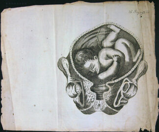 Grafika - Oceloryt - Rok 1778 - Poloha plodu - Fig. 16 (193) (Zpráva o kumštu babském)