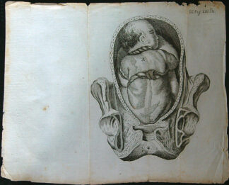 Grafika - Oceloryt - Rok 1778 - Poloha plodu - Fig. 22 (310) (Zpráva o kumštu babském)