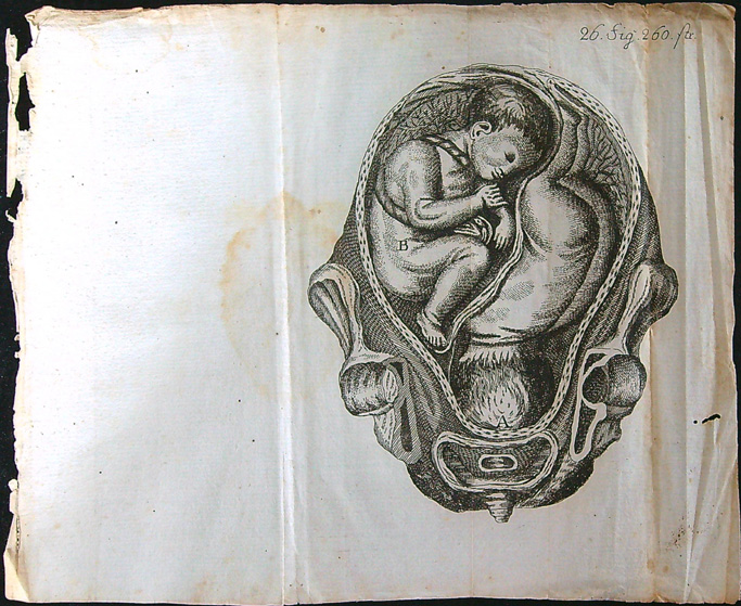 Grafika - Oceloryt - Rok 1778 - Poloha plodu - Fig. 26 (260) (Zpráva o kumštu babském)