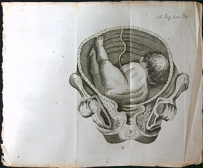 Grafika - Oceloryt - Rok 1778 - Poloha plodu - Fig. 18 (200) (Zpráva o kumštu babském)